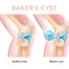 Massage, Bodywork and Baker's Cysts