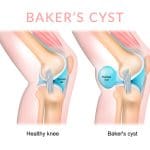 Illustration of healthy knee compared to a knee with a Baker's or popliteal cyst