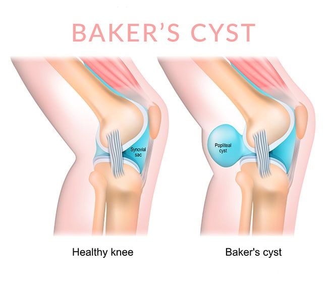 Illustration of healthy knee compared to a knee with a Baker's or popliteal cyst