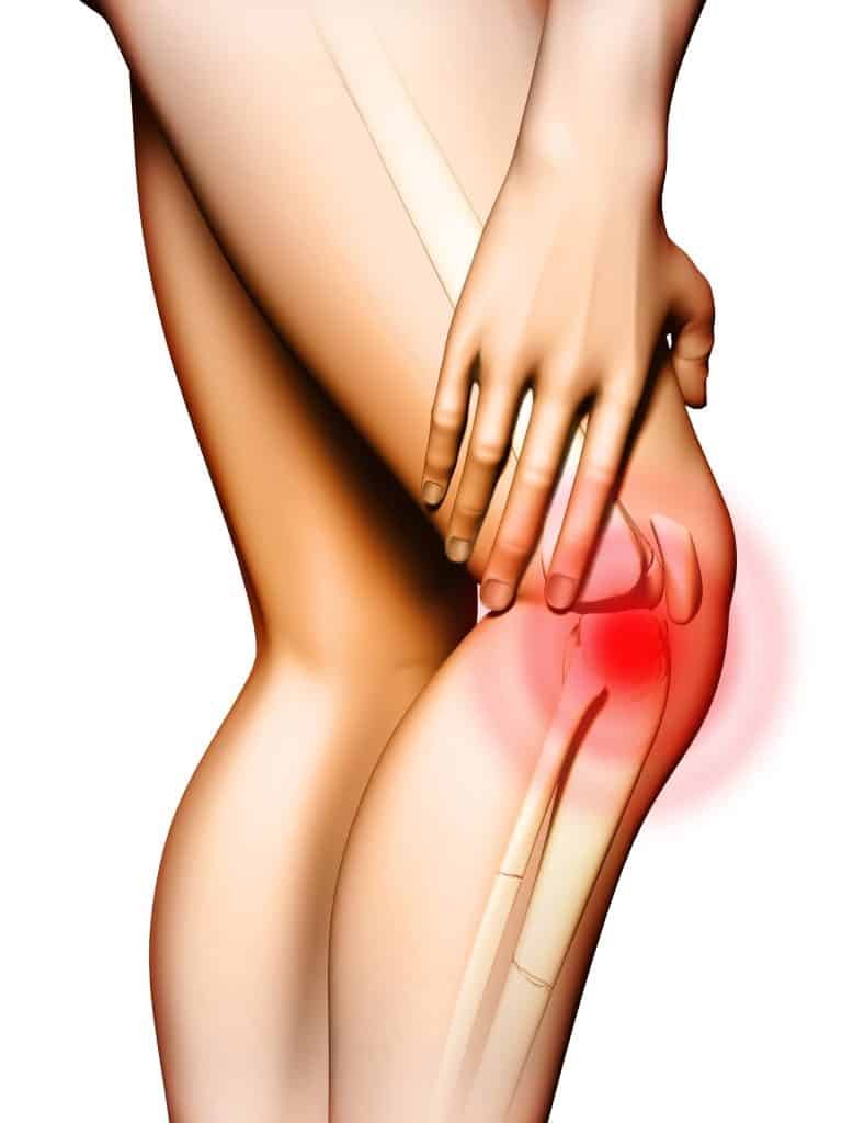 Side image of woman's leg demonstrating pain radiating from the knee